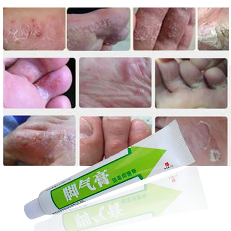 Традиционный китайский крем для ног забота о ногах спортсменов зуд волдыри