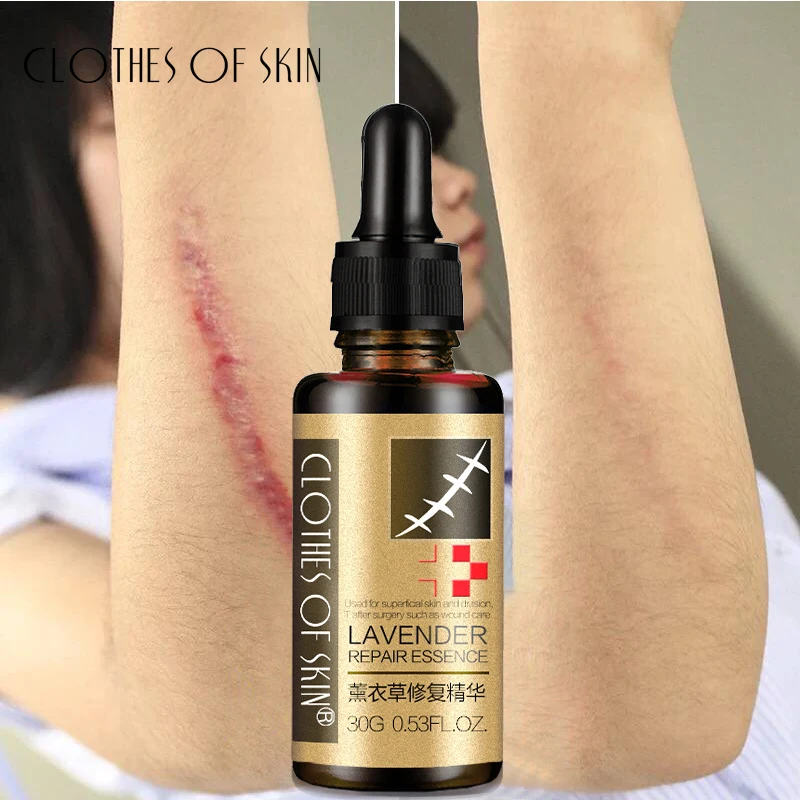 

Lavender Scar Removal Serum Hyaluronic Acid Remove Acne Scar Stretch Marks Acne Spots Treatment Skin Repair CLOTHES OF SKIN