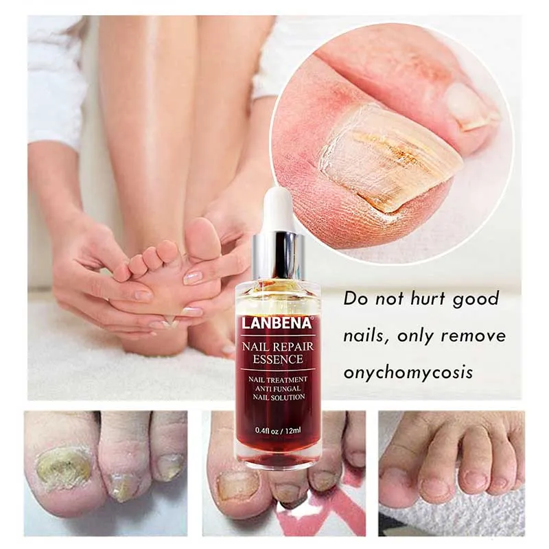 

Fungal Nail Repair Essence Serum Treatment Care Foot Nail Fungus Removal Gel Anti Infection Paronychia Onychomycosis