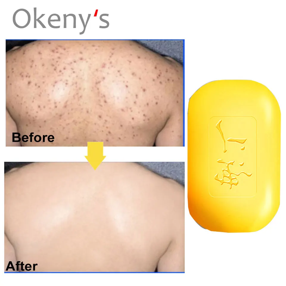 Средство для удаления угрей и традиционное китайское Отбеливающее моющее