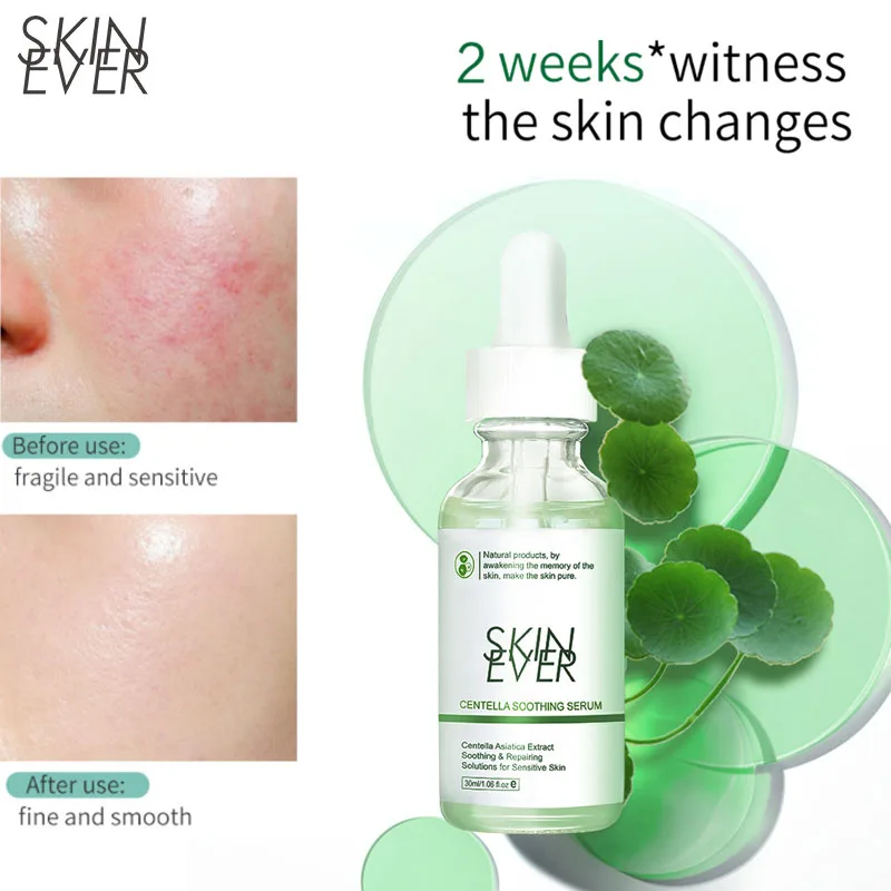 

SKIN EVER Centella Repair Serum Acne Treatment Anti Aging Soothing Moisturizer Shrink Pores Oil Control Whiten Skin Care Unisex