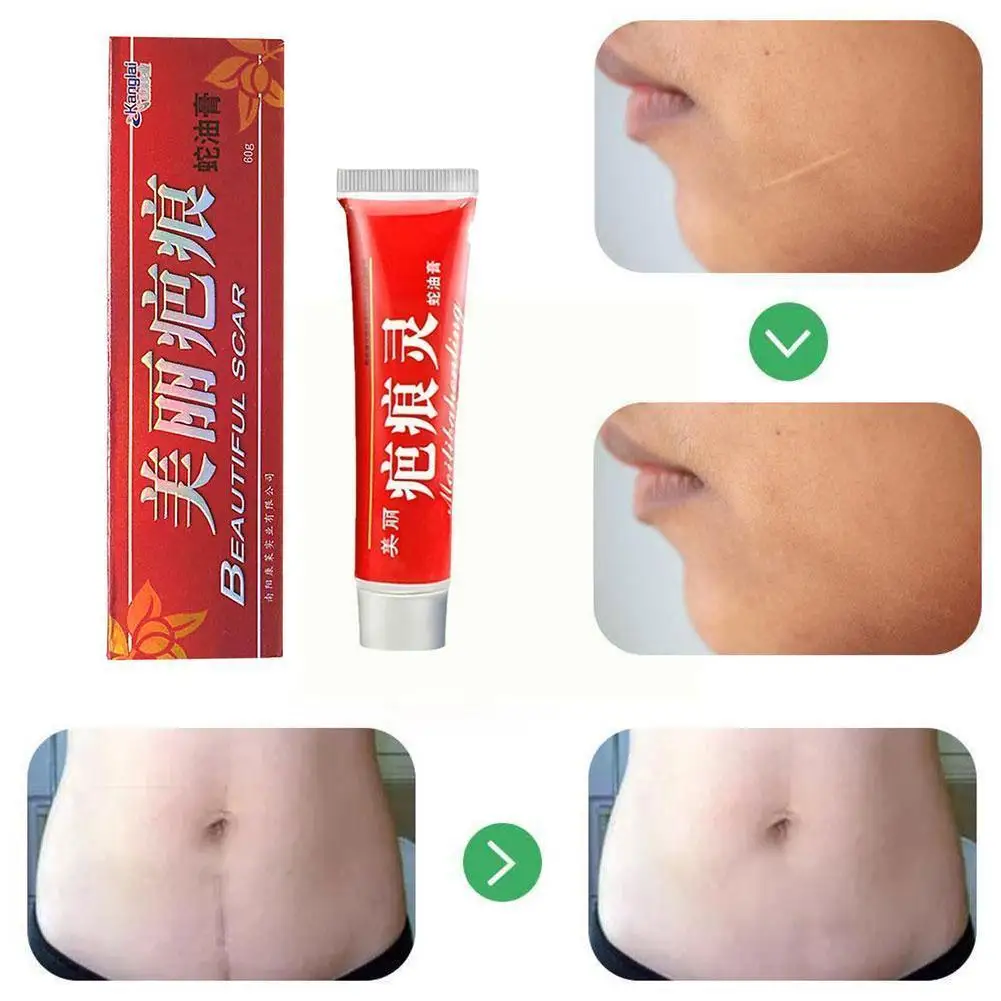 

Skin Care Acne Scar Removal Cream Skin Repair Ointment Acne Cream Stretch Cream Face Spots Treatment Mark Remover Acne V1C9