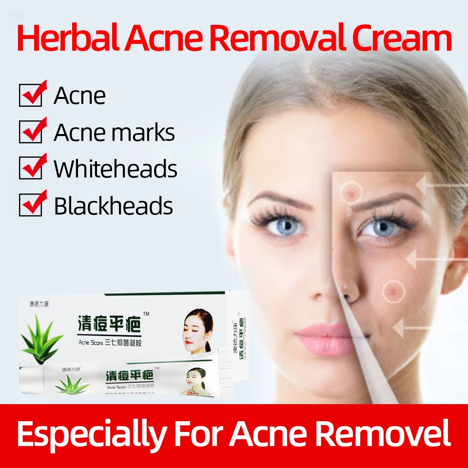 

Лечебный антибактериальный гель для удаления прыщей, шрамов, угрей, отбеливающий крем для ухода за кожей