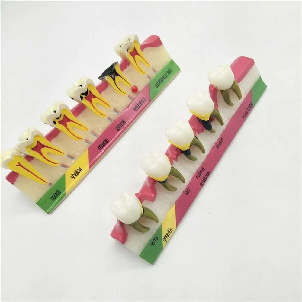 

Periodontal Disease Model/Dental Model