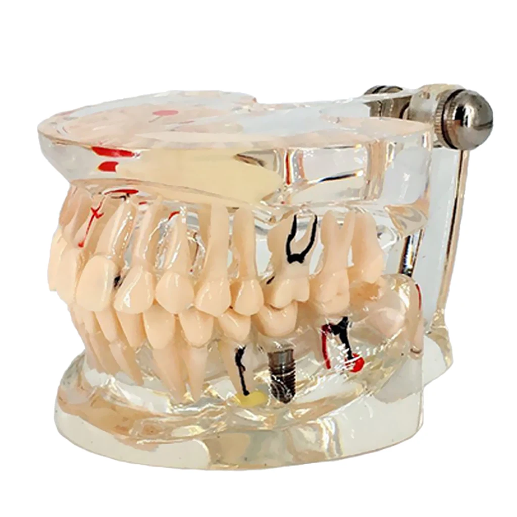 

Teeth Model with Ceramic and Self-Ligating Metal Brackets Clear