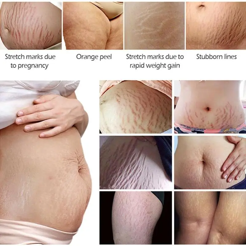 

30ml Remove Stretch Marks Repair Cream Smooth Body Repair Skin Lines Obesity Skin Firm New Skin Care Maternity Scars Z5W4