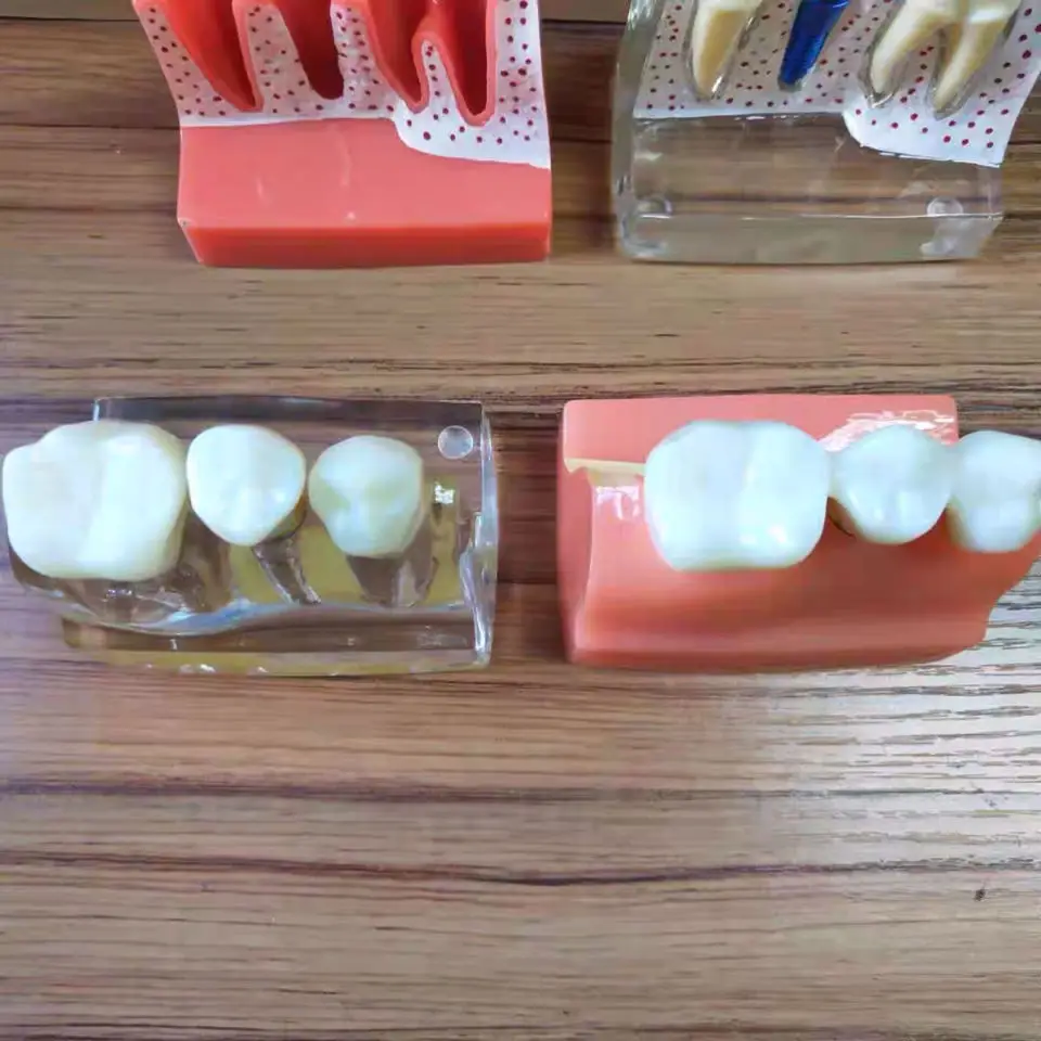 1 шт. 4 кратная модель имплантатов зубов орального обучения стоматологической