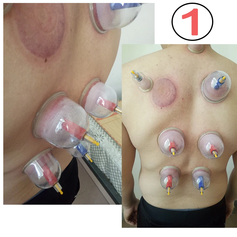 Набор медицинских банок для вакуумного массажа вакуумные банки расслабления и