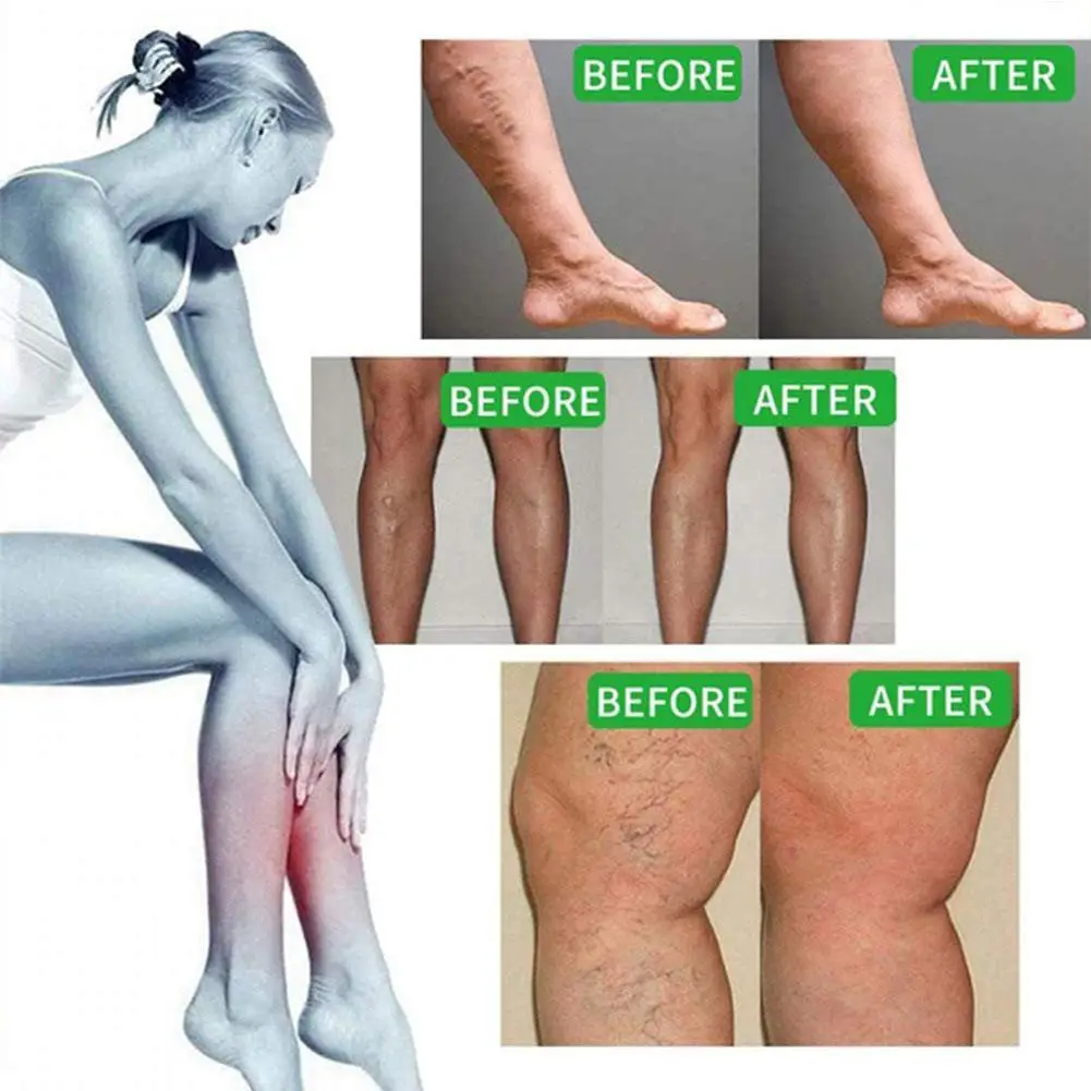 

1Pcs 25g Varicose Veins Ointmnet Vasculitis Phlebitis Spider Cream Varicosity Angiitis Removal Herbal Medical Plaster