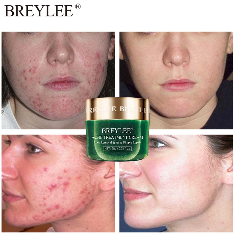 

BREYLEE Tea Tree Acne Treatment Face Cream Anti Acne Pimple Removal Spots Oil Control Shrink Pores Moisturizing Skin Care 20g