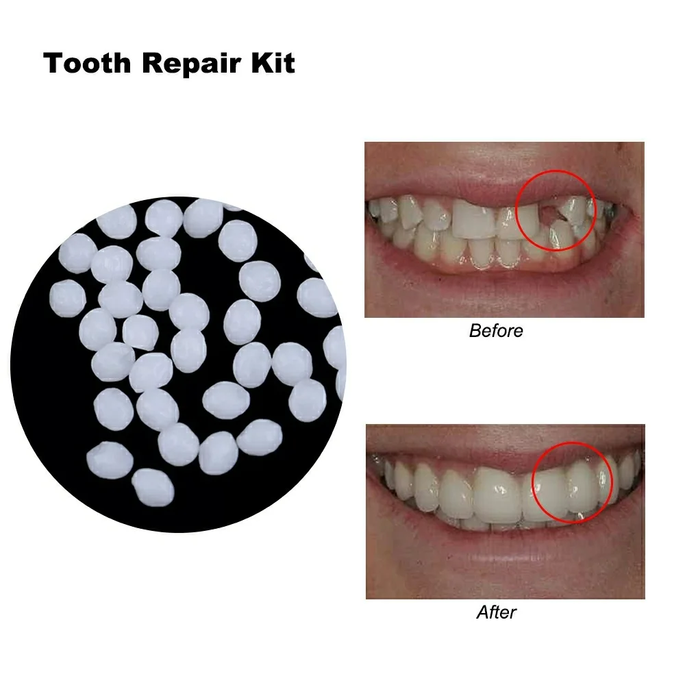 20g Temporary Tooth Filling Replacement Material  White Replace Missing Denture Adhesive  DIY Teeth Glue Repair Kit Dental