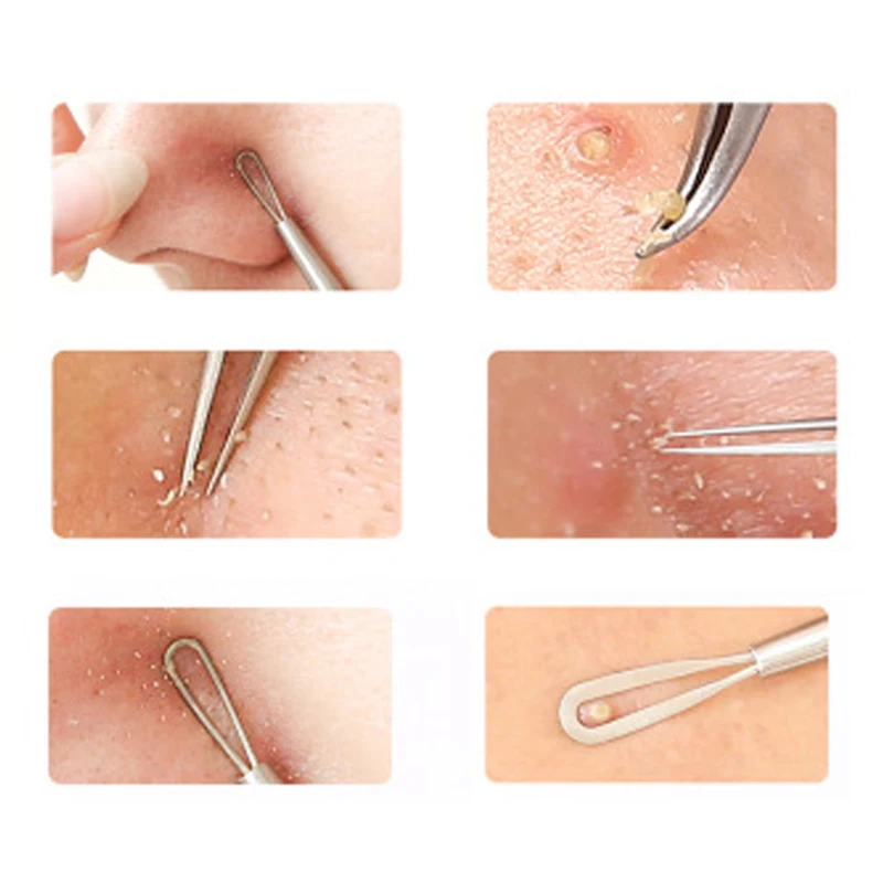 

Silver Blackhead Comedone Extractor Acne Tool Blemish Extractor Pimple Remover Cosmetic Tool Stainless Acne Needles Removal