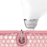 Устройство для удаления угрей#5