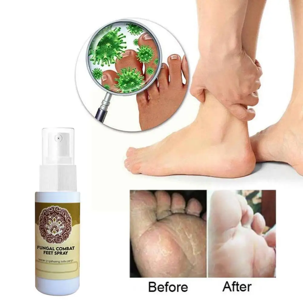 

Feet Care Spray Anti Fungal Infections Remover Foot Odor Sweat Plant Herb Foot Spray For Beriberi Itch Erosion Peeling Blis G7i3