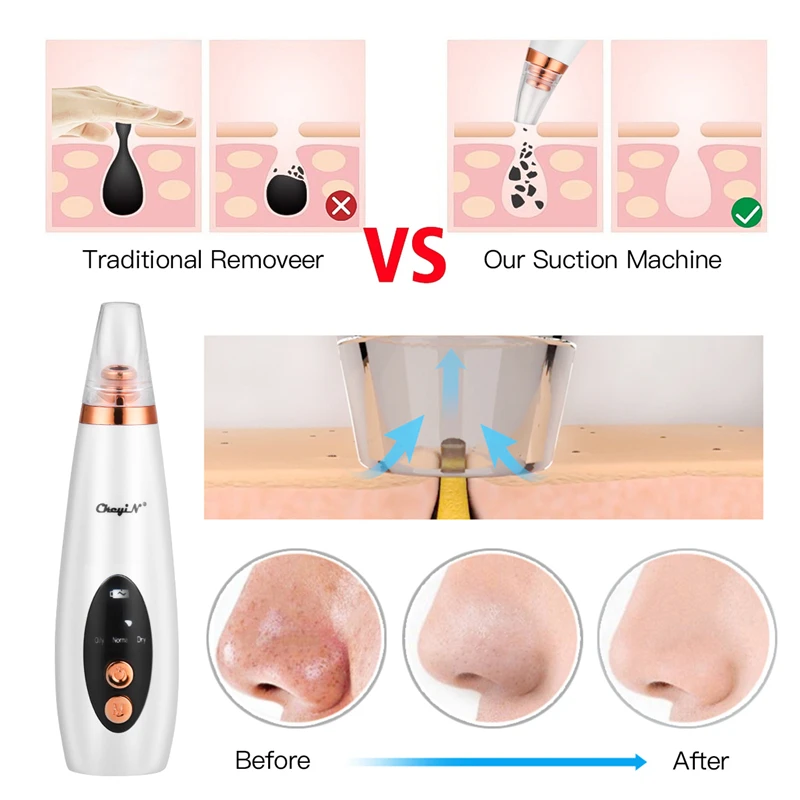 

CkeyiN 6 In 1 Blackhead Remover Skin Care Pore Vacuum Acne Pimple Removal Suction Tool Facial Deep Cleansing Face Skin Machine
