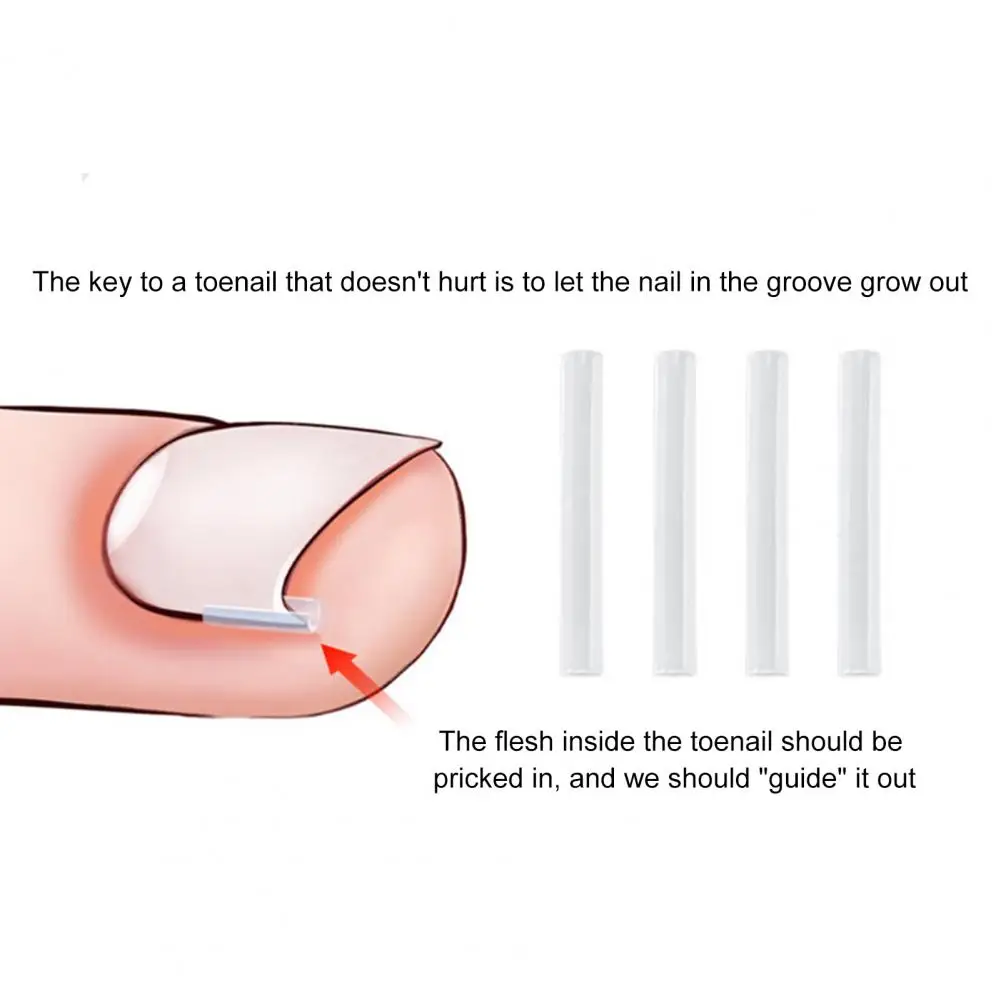 

10Pcs Toenail Straightening Ingrown Correction Tool Nail Patch Sticker Foot Care