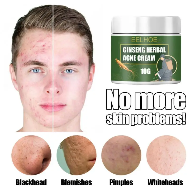 

Крем для удаления угрей с женьшеня, дезальт, акне, шрамов, акне, восстанавливающий крем от акне, отбеливающий увлажняющий крем для тела, уход ...