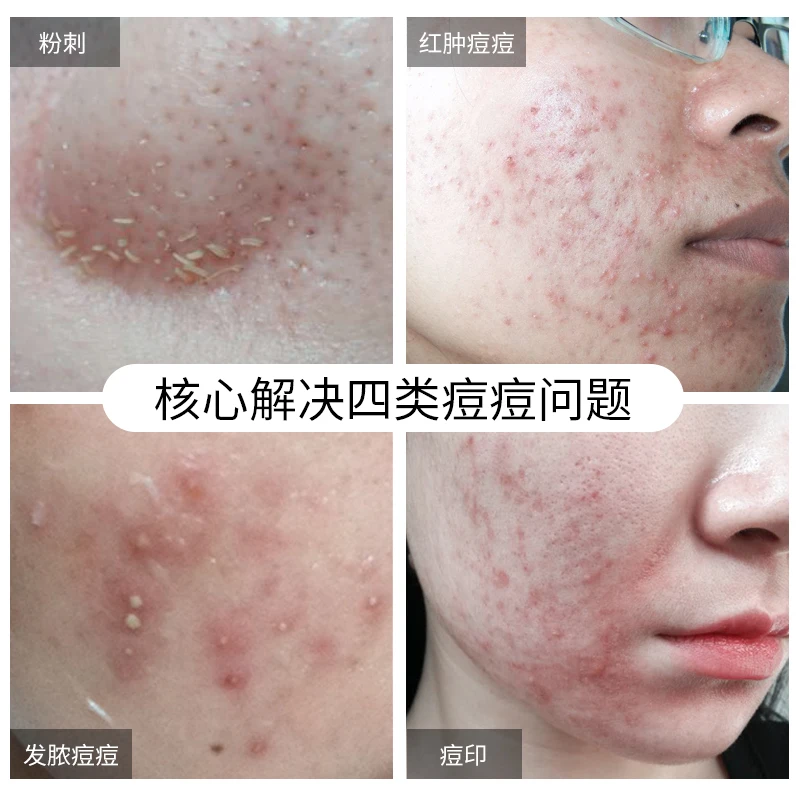 Quartxery быстрое удаление Ance отбеливающий увлажняющий крем для удаления кожи мужчин