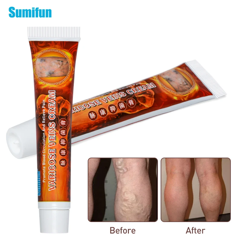 

20g Sumifun Varicose Veins Treatment Cream 100% Original Vasculitis Phlebitis Spider Pain Relief Ointment Medical Plaster