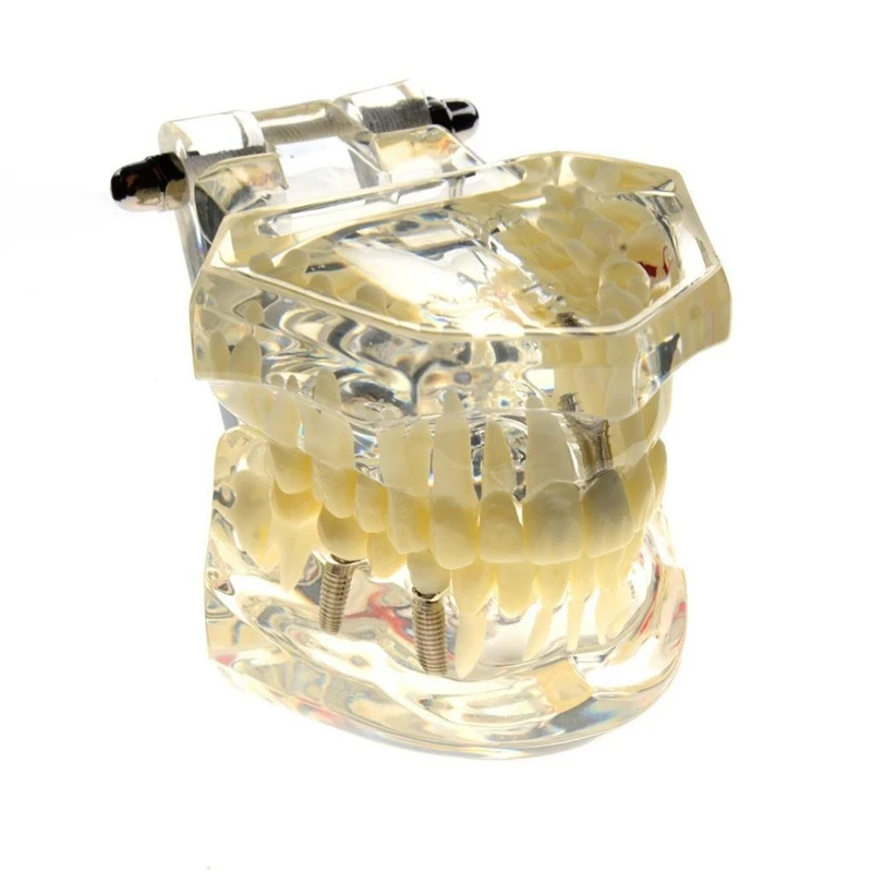 Имплантант болезни зубов Модель с восстановлением мост зубной Стоматолог для