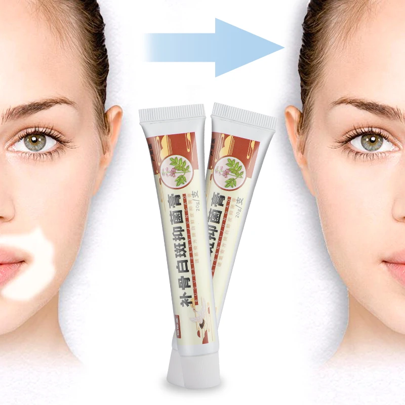 

20g vitiligo ointment antibacterial cream for local fungal disease and vitiligo repair medical plaster