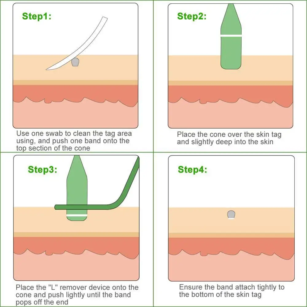 Средство для удаления шкуры Vamop средство бородавок домашнего использования
