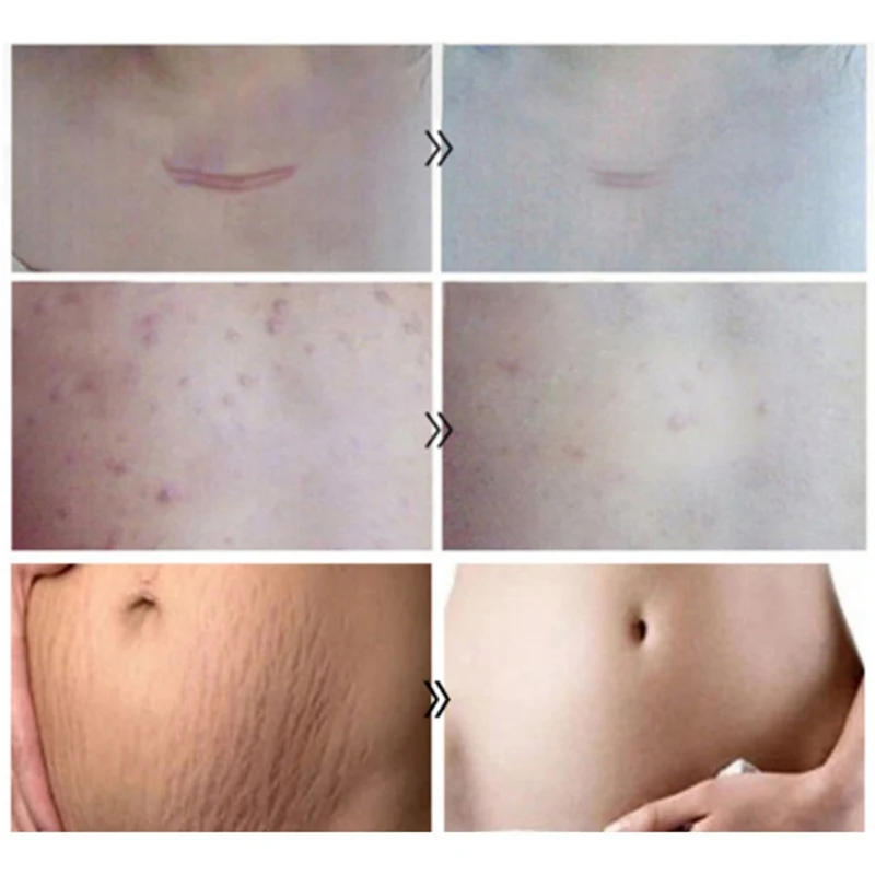 20g Hydrating Remove Pimple Marks Face Serum Repair Essential Liquid Quick Repair Scar Skin Smoothing Cream