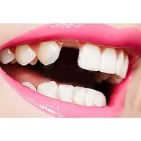 false tooth dentures temporary filling material replace missing gap slit cavities repair dental tools diy replacement removable