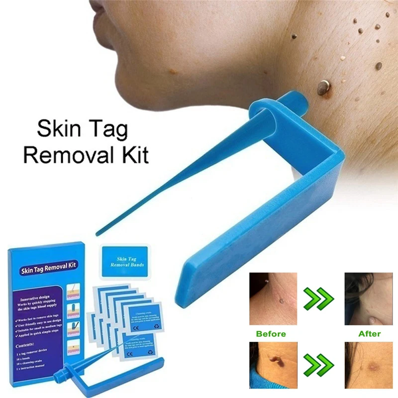 Медицинская Non токсический кожу средство удаления бирок инструмент для взрослых