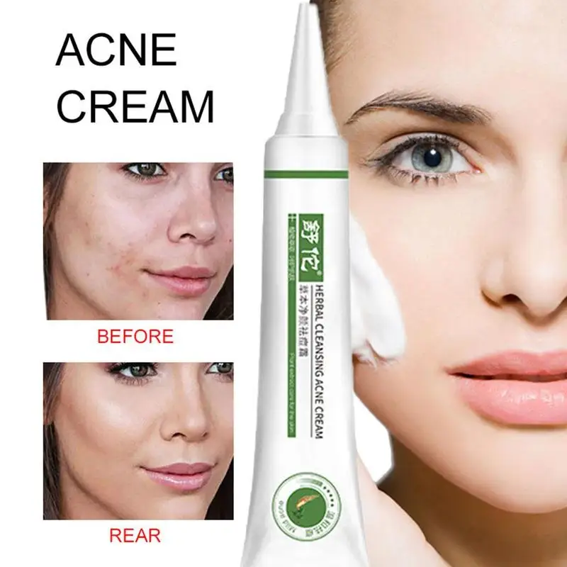 26G Repair Cleansing Acne Cream Acne Anti Acne Treatment Whitening Scar Moisturizing Blackhead Cream G4X7