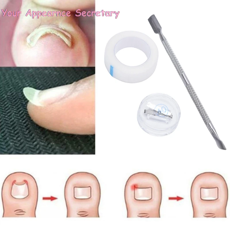 

Ingrown Toe Nail Correction Buckle Patch Pedicure Toenail Fixer Foot Care Tool