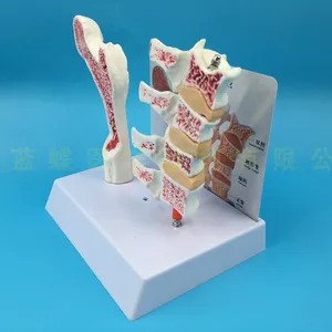 4D человеческий Бедренный остеопороз анатомическая модель ноги костной поверхности позвоночника раздел образцы больного поясничного отдела позвоночника модель
