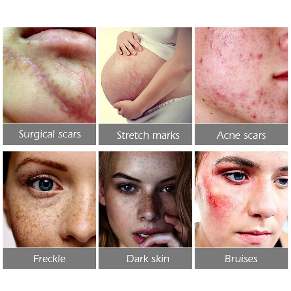 30 г крем удаляющий Шрамы Акне прямые от угревой сыпи гель для лица удаления угрей