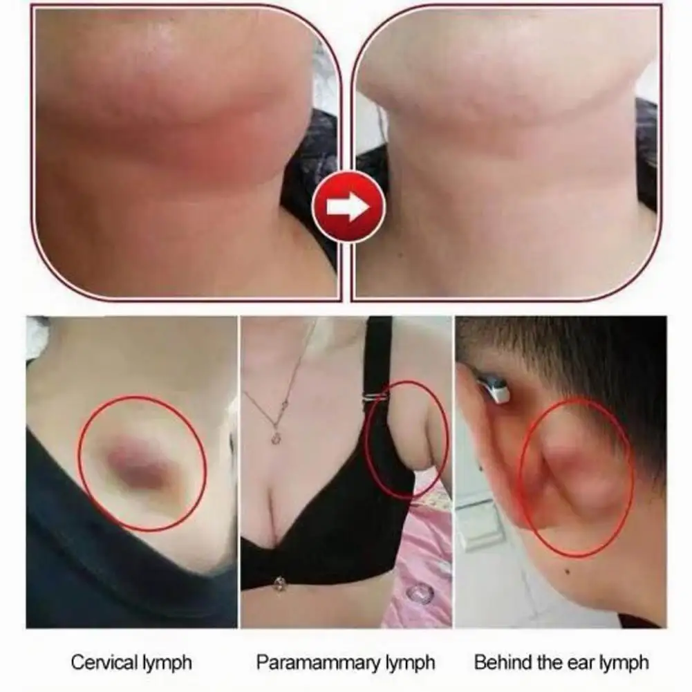 

Effective Lymph Nodes Patch Breast Lymphatic Drainage Plaster Anti-Swelling Neck Neck Lymphatic Detox Patch prevent disease