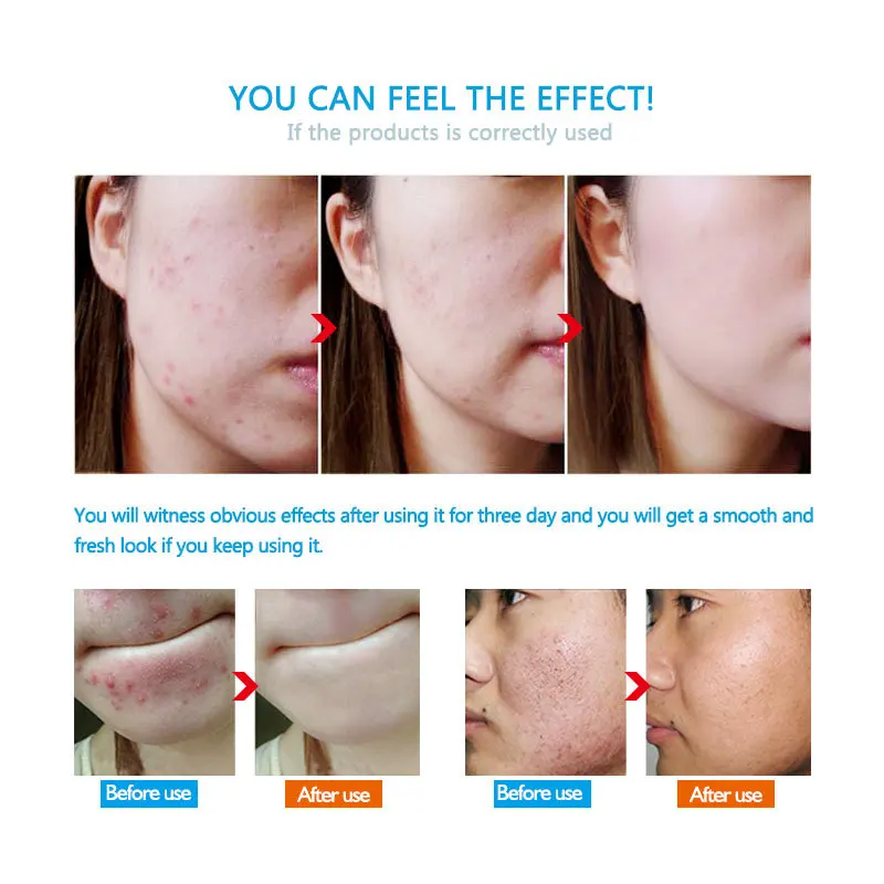 

Effective Acne Cream Anti Spots Acne Treatment Scar Blackhead Cream Shrink Pores Whitening Moisturizing Skin Care 20g