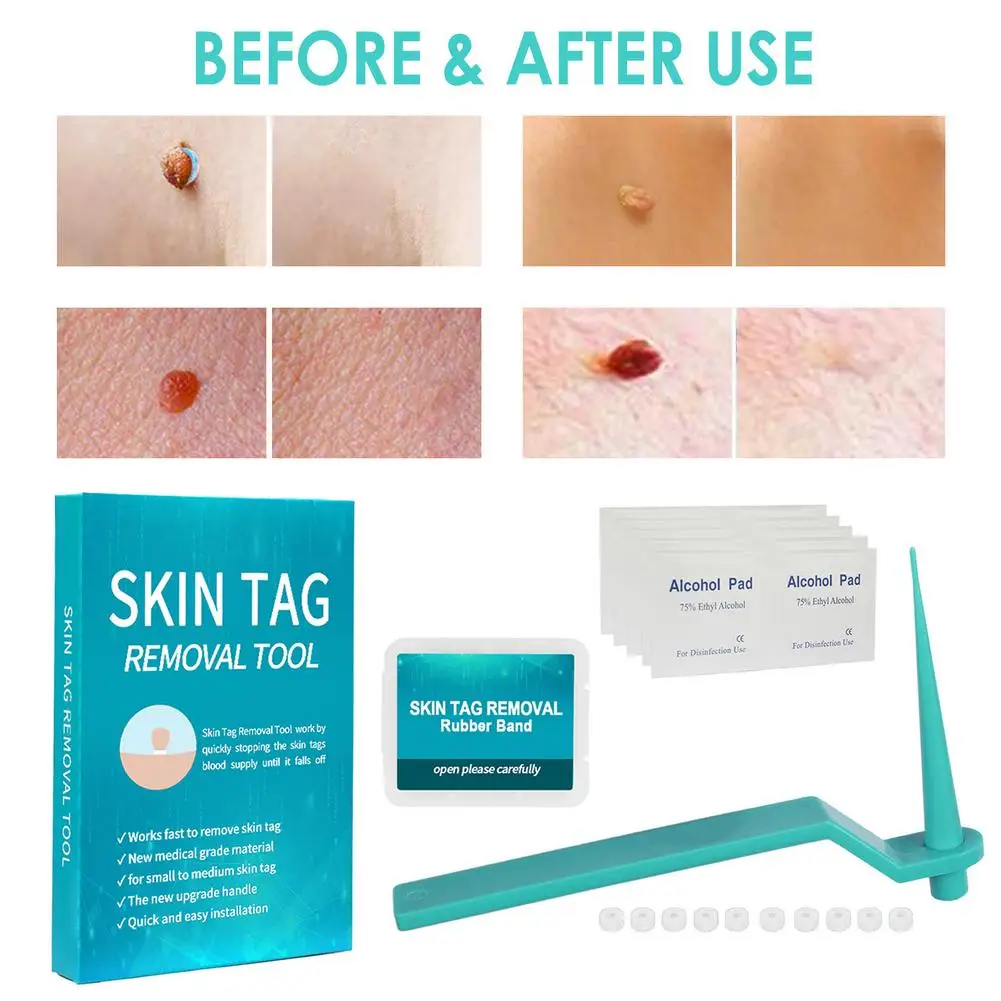 

Micro Band Non Toxic Face Care Mole Wart Tool For Blue Skin Tag Removal Kit With Cleansing Swabs Rubber Ring Home Use