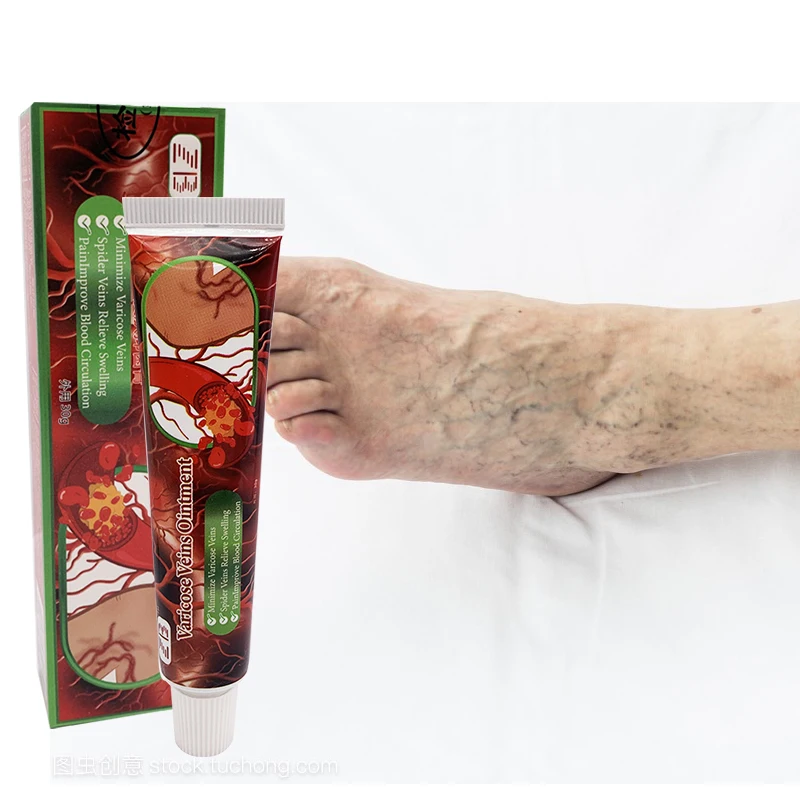 

30g Varicose Veins Ointment Cream Relief Pain For Vasculitis Phlebitis Tube Effective Varicose Vein Relief Cream