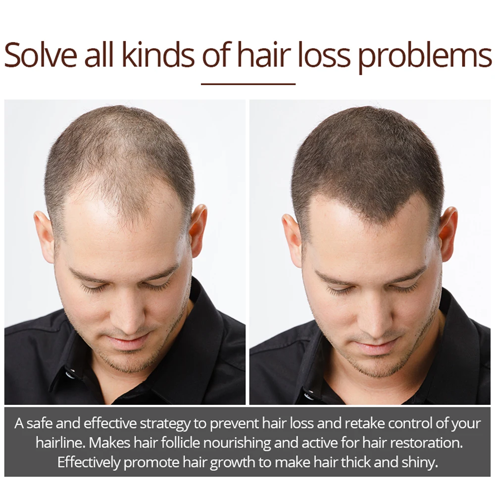 Hair growth promoting essential oil liquid spray nourish the roots of a thick shiny hair loss prevention men and women can | Красота и