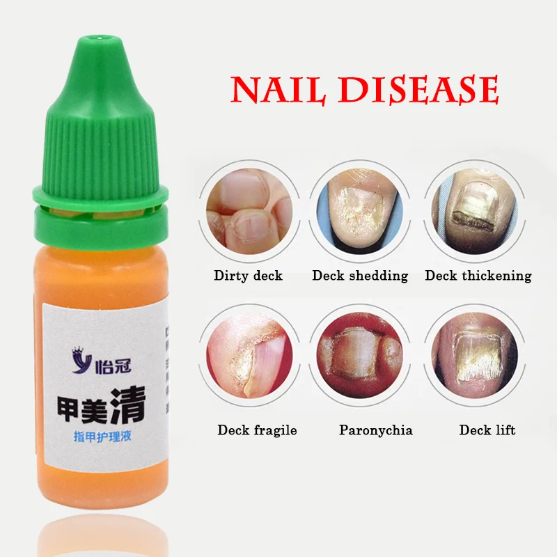 1 шт. Лечение ногтей онихомикоз паронихия противогрибковая инфекция хороший