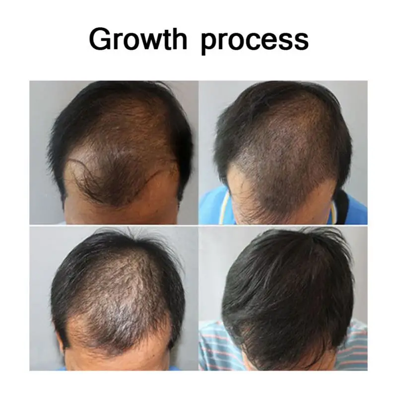 

Wholesale Hair Growth Liquid Nourish Hair Roots Thick And Glossy Hair Growth Anti-hair For Men And Women