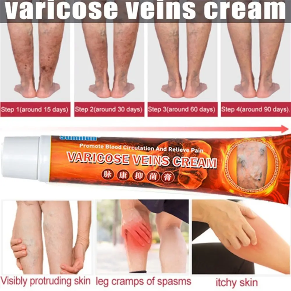 

Phlebitis Legs Varicose Angiitis Vasculitis Cream Herbal Medical Plaster Varicose Veins Ointment Cream Treatment