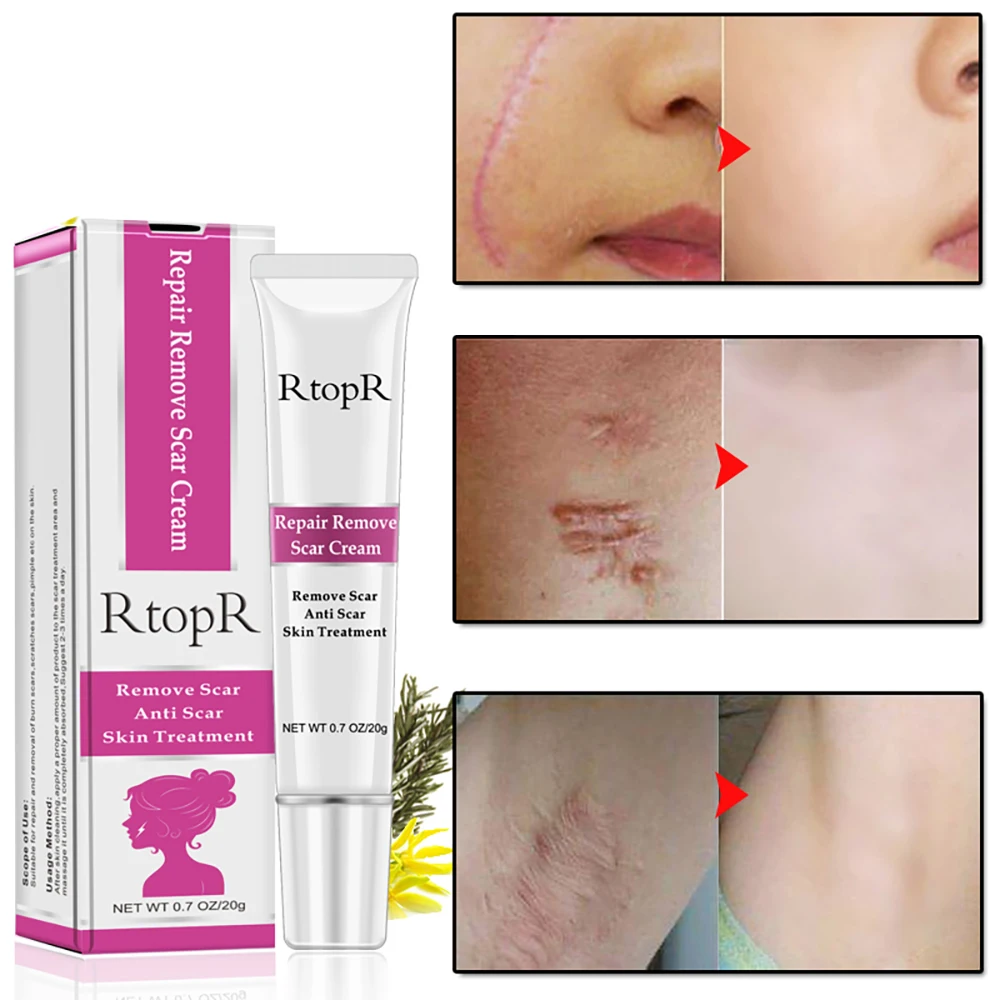 

RtopR Acne Scar Stretch Marks Remover Cream Blackhead Whitening Moisturizing Facial Skin Care Ointment Repair Acne Cream TSLM2