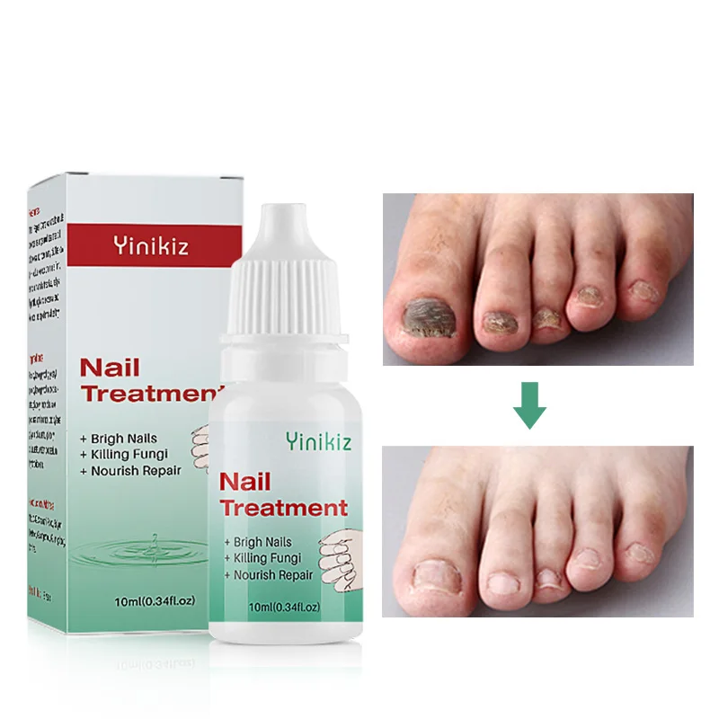 Лечение трав грибка для ногтей Удаление ног гель ухода за ногами эссенция