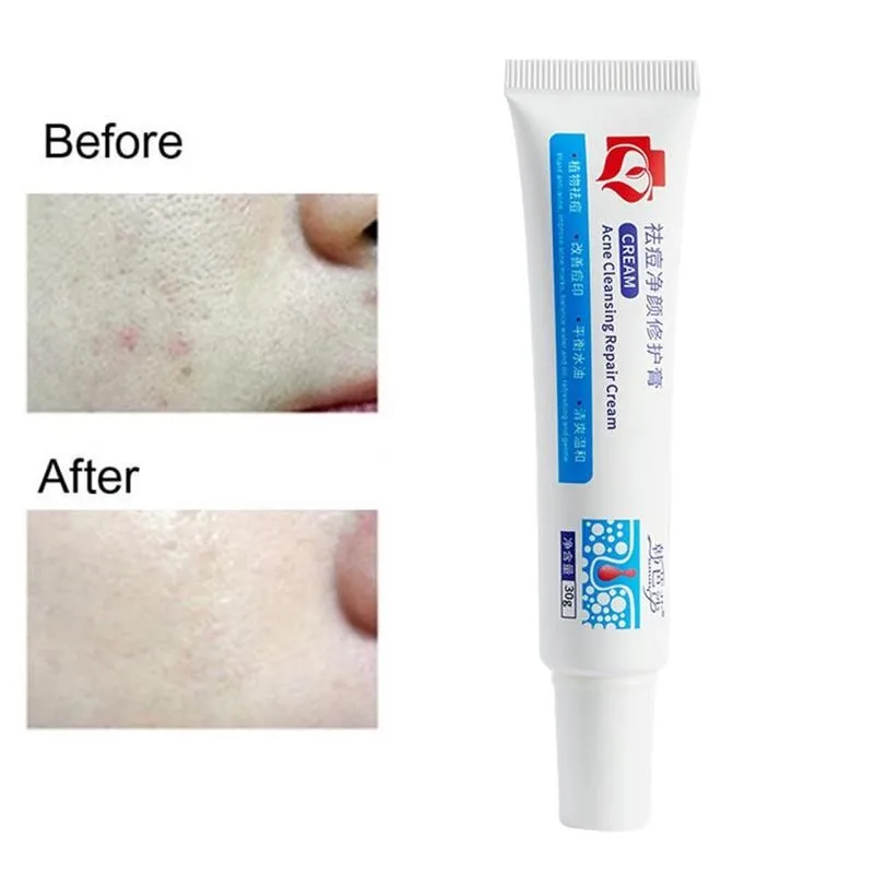 30g Acne Treatment Face Cream Blackhead Repair Gel Removal Whitening Acne Care Skin Pores Scar Cream Shrink W5G2
