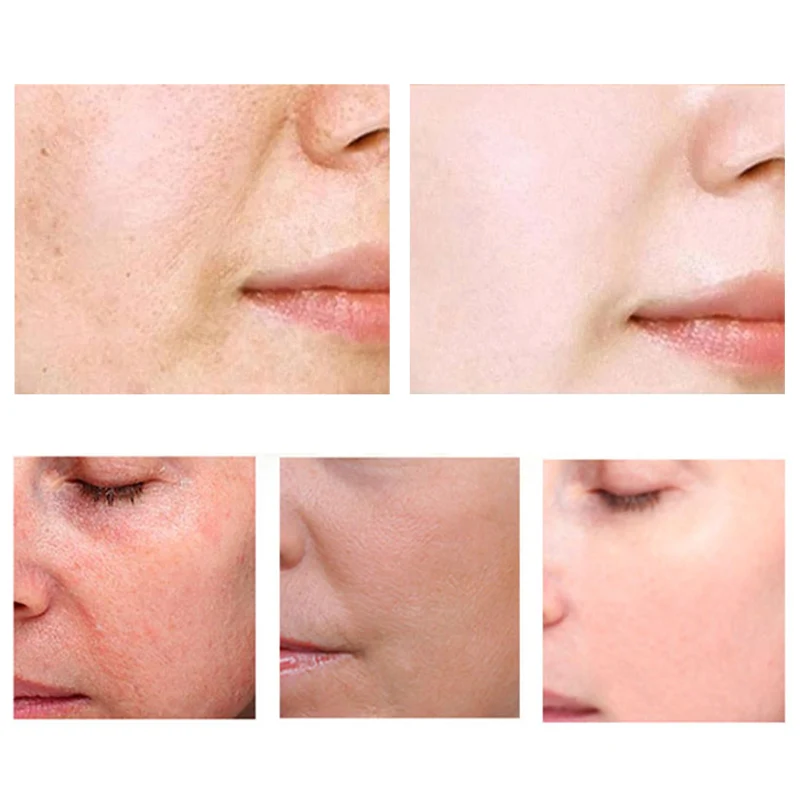 VENZEN 5 шт./компл. Золотой протеиновый пептид для лица шелковая линия резьба