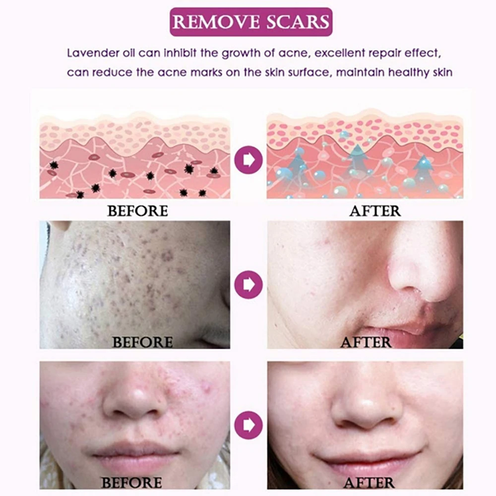 Эфирное массажное масло для удаления шрамов эссенция восстановления лаванды