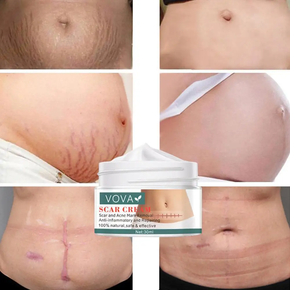 

30g Acne Scar Removal Cream Pimples Stretch Marks Face Smoothing Body Care Remove Whitening Acne Skin Gel Moisturizing A0A9
