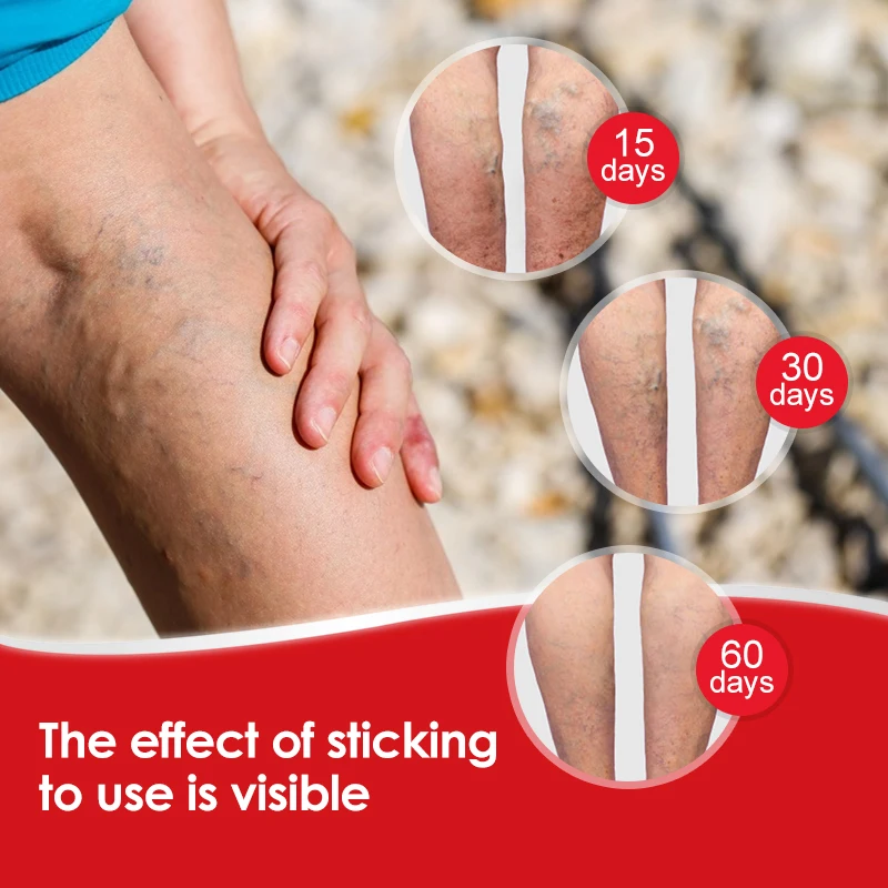 Sumifun 6/18/30/48pcs Chinese Varicose Veins Plaster Vasculitis Phlebitis Spider Leg Medical Patch Angiitis Removal | Красота и