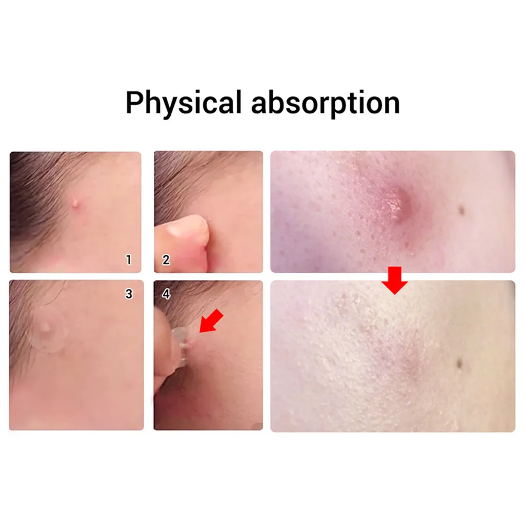 Patch Acne Pimple Master Invisible Stickers Skin Face Spot Scar Care facial skin care blackhead removal Freckle acne mask #1223