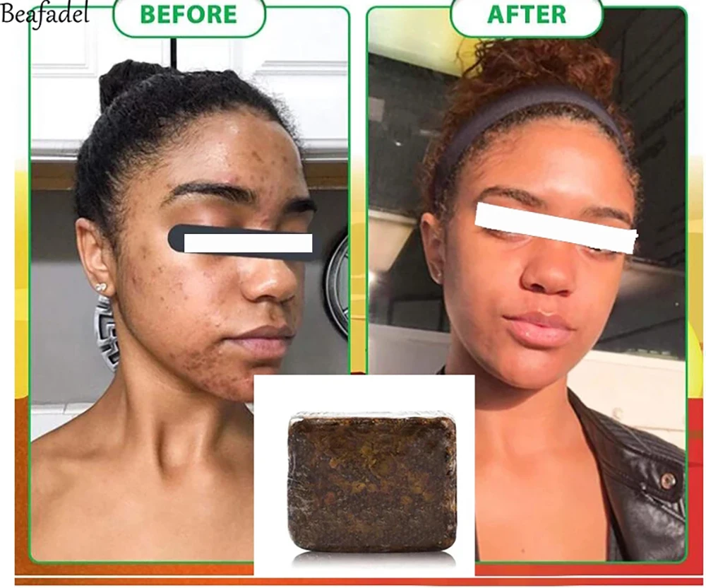 

Natural African Black Soap Magic Anti Rebelles Moisturizing Shea Butter Bath Body Treatment strong whitening Acne Skin Care